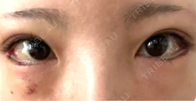 タレ目形成・グラマラスライン（切開） アリエル美容クリニック 横浜院 DAY 14 メイン用