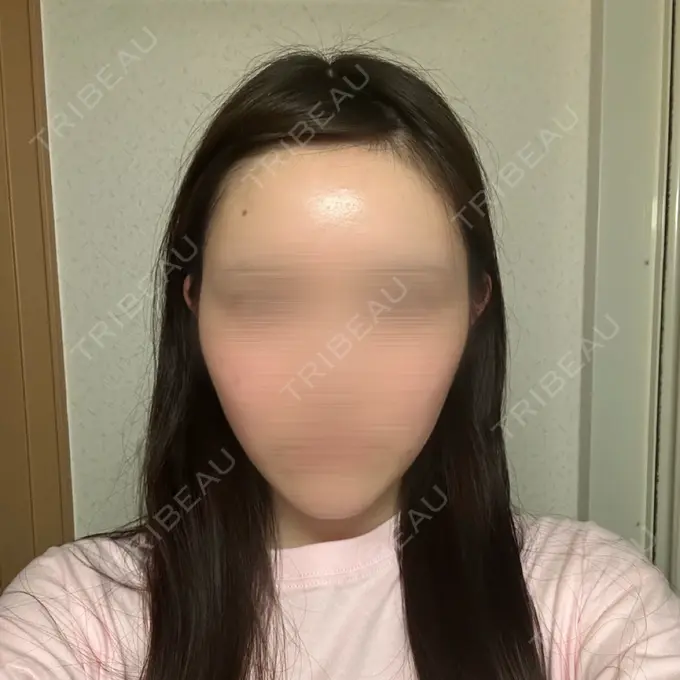 糸リフト 東京シンデレラ美容外科 池袋院 DAY 17 メイン用