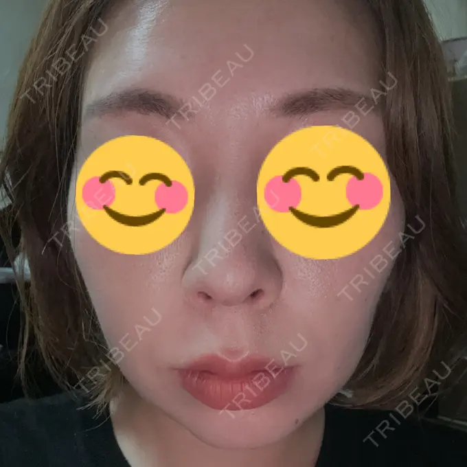 糸リフト / その他（輪郭） PRISM Beauty Clinic 町田院 AFTER メイン用