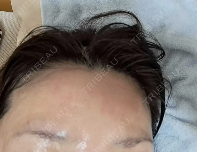 ピーリング（ニキビ・毛穴） / エレクトロポレーション / ピーリング（ハリ・ツヤ） SK新宿歌舞伎町美容外科・歯科 DAY 13 メイン用