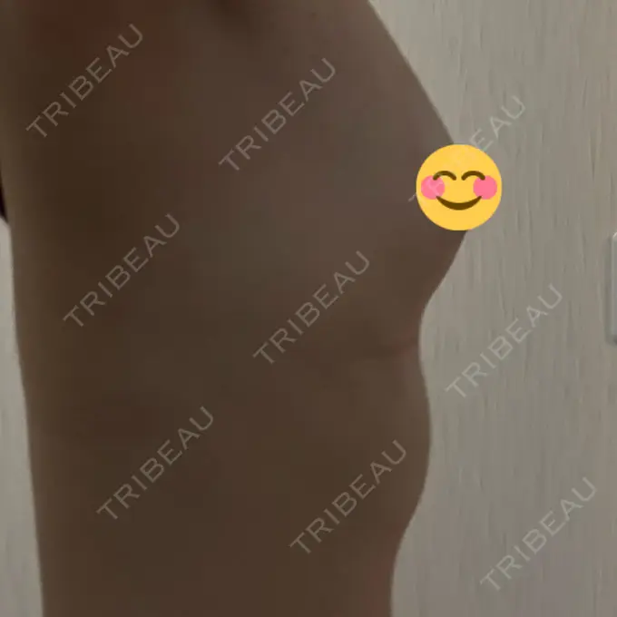 豊胸（脂肪注入） Mods Clinic（モッズクリニック） 名古屋院 DAY 170 メイン用