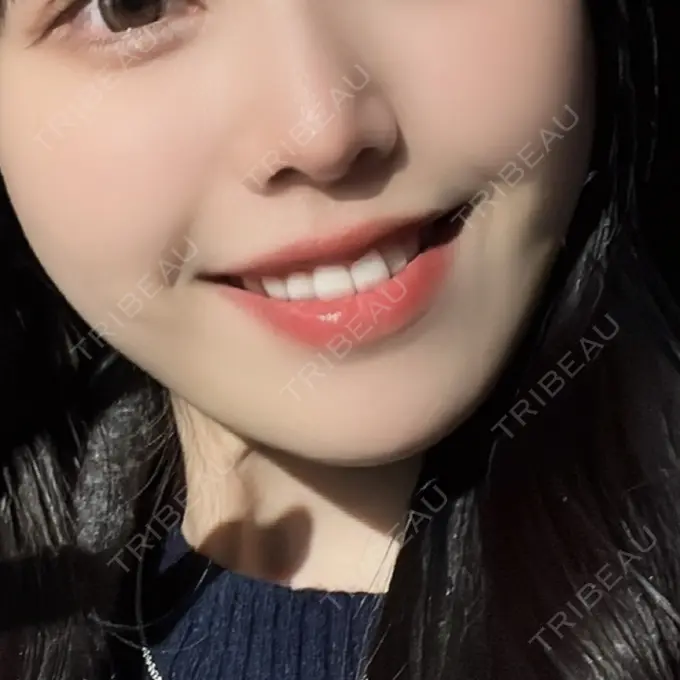 糸リフト / 脂肪吸引（顔） / 脂肪注入（目の下） / ボトックス（あご） / ボトックス（エラ・小顔） / ボトックス（口角） / ボトックス（眉間） 東京ココセランクリニック AFTER メイン用