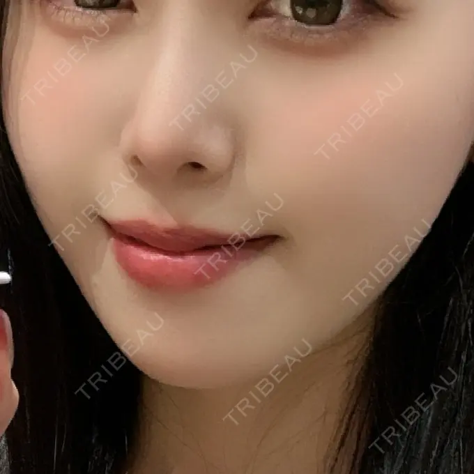 糸リフト / 脂肪吸引（顔） / 脂肪注入（目の下） / ボトックス（あご） / ボトックス（エラ・小顔） / ボトックス（口角） / ボトックス（眉間） 東京ココセランクリニック DAY 25 メイン用