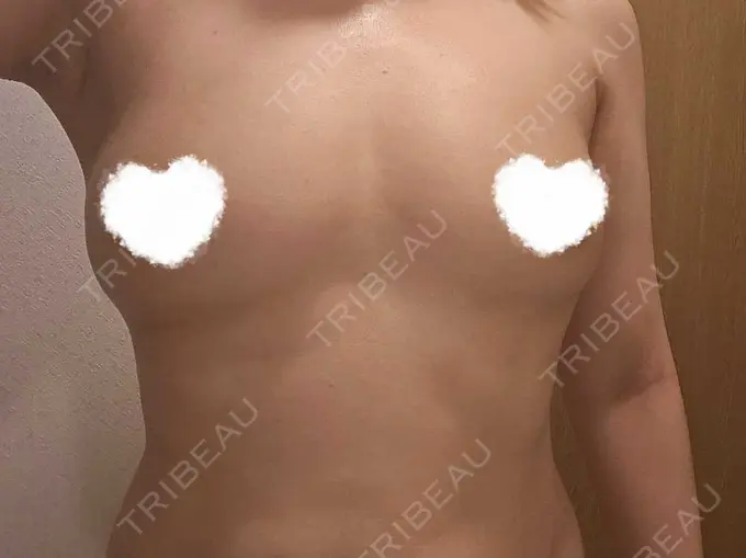 脂肪吸引（二の腕） / 豊胸（脂肪注入） / 脂肪吸引（肩） Mods Clinic（モッズクリニック） 名古屋院 DAY 89 メイン用