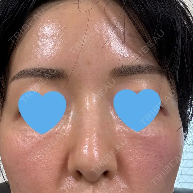 水光注射（ハリ・美肌） / 肌育注射（ジュベルックなど） Chloe Cheongdam Clinic （クロエチョンダムクリニック） DAY 0 メイン用