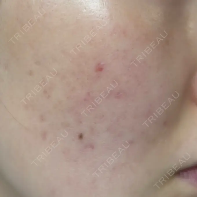 ピーリング（ニキビ・毛穴） / ルメッカ Grias clinic （ジリアスクリニック） DAY 2 メイン用