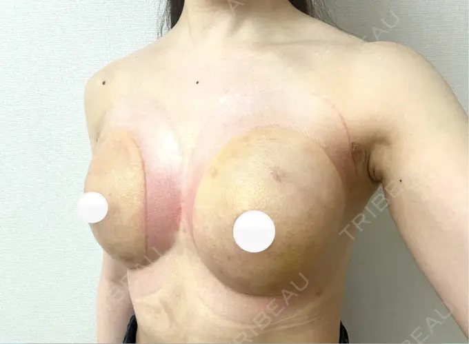 脂肪吸引（脚） / 豊胸（脂肪注入） BUST CLINIC（バストクリニック） 東京 DAY 18 メイン用