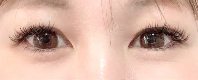 二重埋没 / 上まぶたの脂肪取り 恵聖会クリニック 梅田院 AFTER メイン用