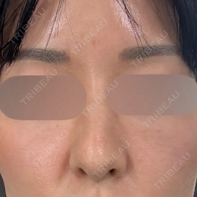 水光注射（ハリ・美肌） / 肌育注射（ジュベルックなど） Chloe Cheongdam Clinic （クロエチョンダムクリニック） DAY 1 メイン用