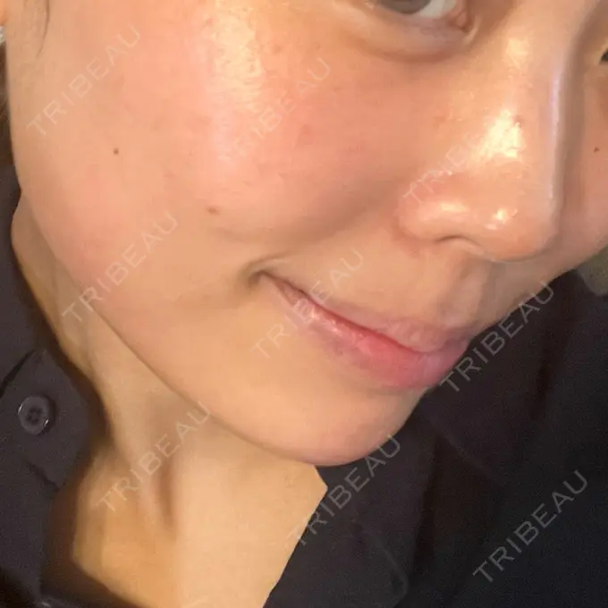 ピーリング（ニキビ・毛穴） / ピコレーザートーニング（美白・肝斑） RainBoW Clinic TOKYO AFTER メイン用