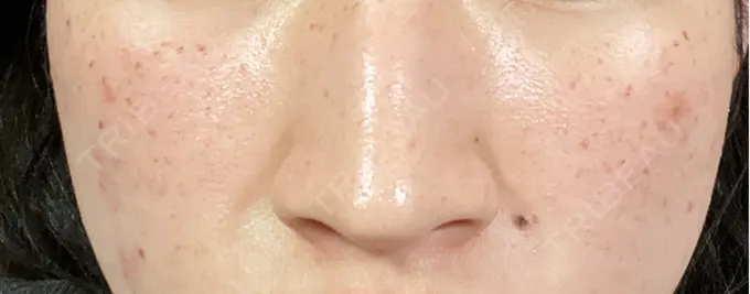 エレクトロポレーション / ピーリング（ハリ・ツヤ） / ルメッカ Otus Clinic 【オータスクリニック】 AFTER メイン用