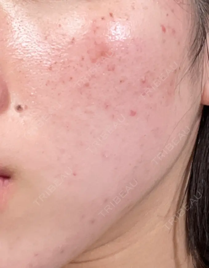 エレクトロポレーション / ピーリング（ハリ・ツヤ） / ルメッカ Otus Clinic 【オータスクリニック】 DAY 1 メイン用