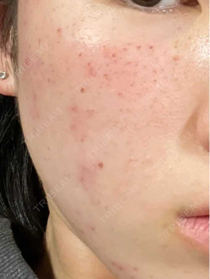 エレクトロポレーション / ピーリング（ハリ・ツヤ） / ルメッカ Otus Clinic 【オータスクリニック】 DAY 1 メイン用