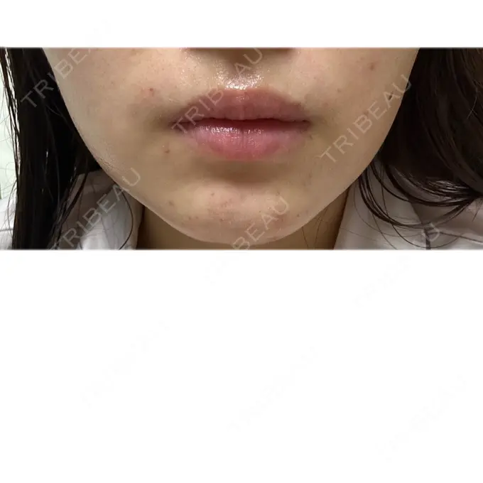 ニードルRF（ポテンツァなど） / アグネス 日本ウェルネス再生クリニック DAY 2 メイン用