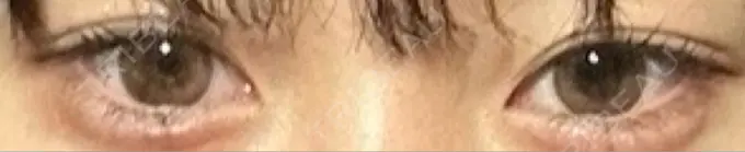 ヒアルロン酸注入（涙袋） フィラークリニック 大阪梅田院 DAY 2 メイン用