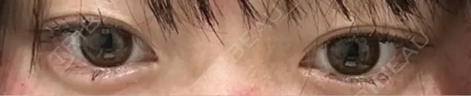 ヒアルロン酸注入（涙袋） フィラークリニック 大阪梅田院 DAY 3 メイン用