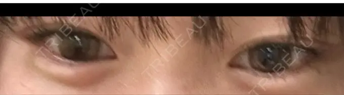 ヒアルロン酸注入（涙袋） フィラークリニック 大阪梅田院 DAY 4 メイン用