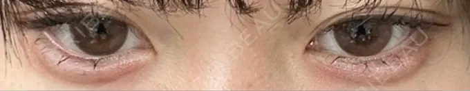 ヒアルロン酸注入（涙袋） フィラークリニック 大阪梅田院 DAY 5 メイン用