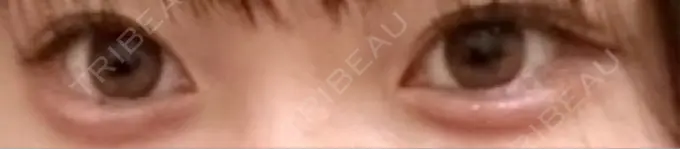 ヒアルロン酸注入（涙袋） フィラークリニック 大阪梅田院 DAY 6 メイン用