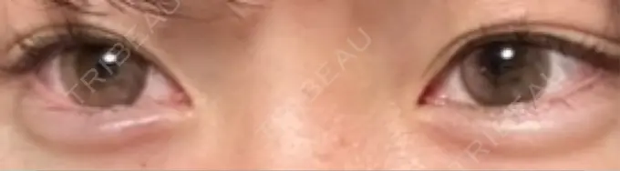 ヒアルロン酸注入（涙袋） フィラークリニック 大阪梅田院 DAY 7 メイン用