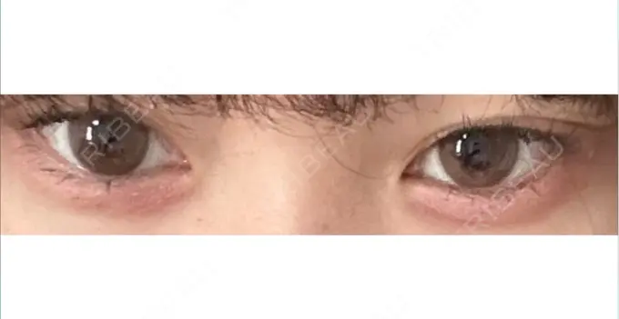 ヒアルロン酸注入（涙袋） フィラークリニック 大阪梅田院 DAY 9 メイン用