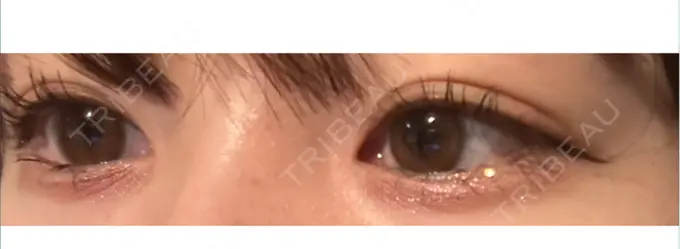 ヒアルロン酸注入（涙袋） フィラークリニック 大阪梅田院 AFTER メイン用