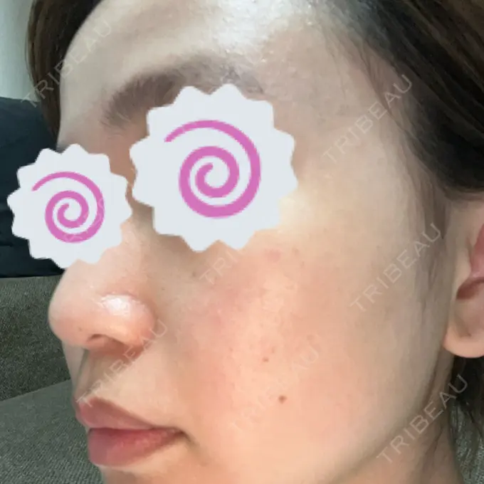 ピーリング（ニキビ・毛穴） 東京素肌クリニック 銀座本院 AFTER メイン用