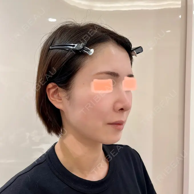 隆鼻術 / 軟骨移植 / 毛穴洗浄（ハイドラフェイシャルなど） / その他（鼻） BIANCA銀座 DAY 35 メイン用