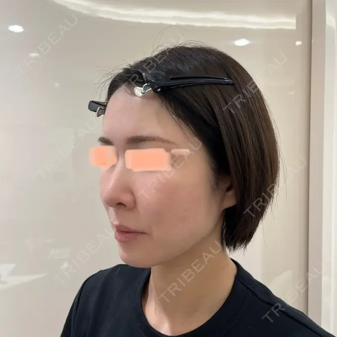 隆鼻術 / 軟骨移植 / 毛穴洗浄（ハイドラフェイシャルなど） / その他（鼻） BIANCA銀座 DAY 35 メイン用