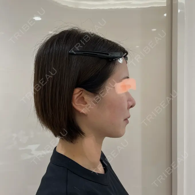 隆鼻術 / 軟骨移植 / 毛穴洗浄（ハイドラフェイシャルなど） / その他（鼻） BIANCA銀座 DAY 35 メイン用