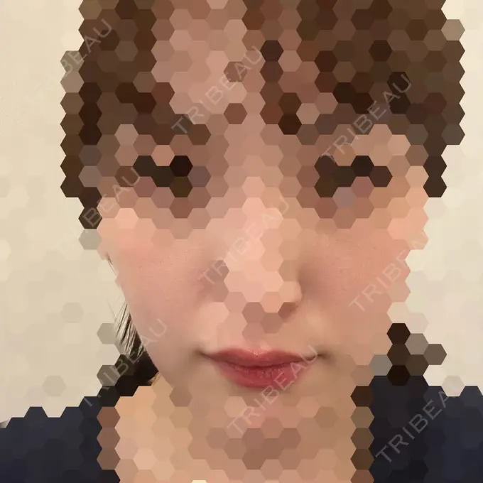 ほくろ・いぼ切除（肌） 吉祥寺アイビークリニック AFTER メイン用