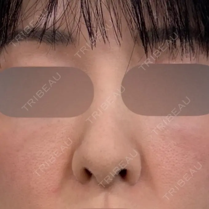 水光注射（ハリ・美肌） / 肌育注射（ジュベルックなど） Chloe Cheongdam Clinic （クロエチョンダムクリニック） AFTER メイン用