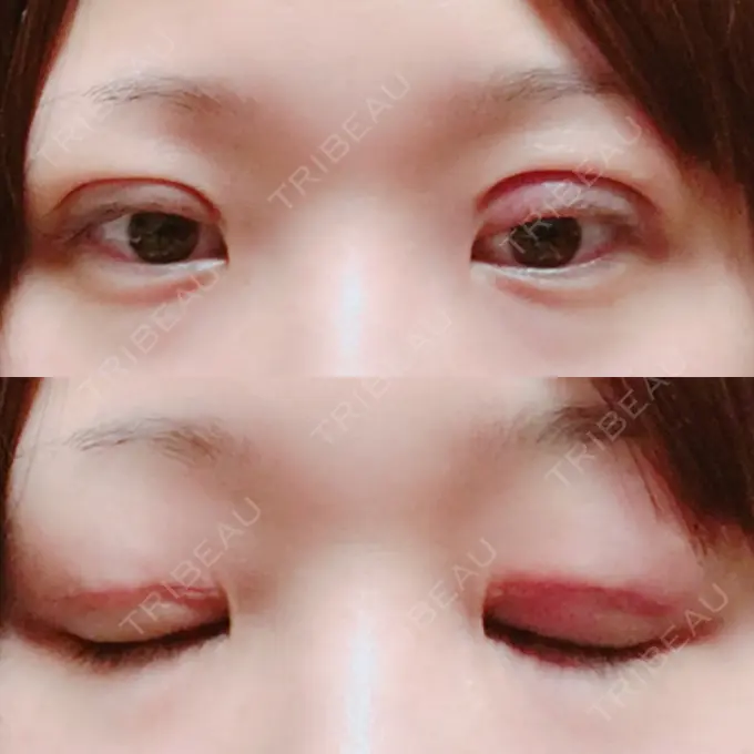 二重切開 城本クリニック 豊橋院 DAY 14 メイン用