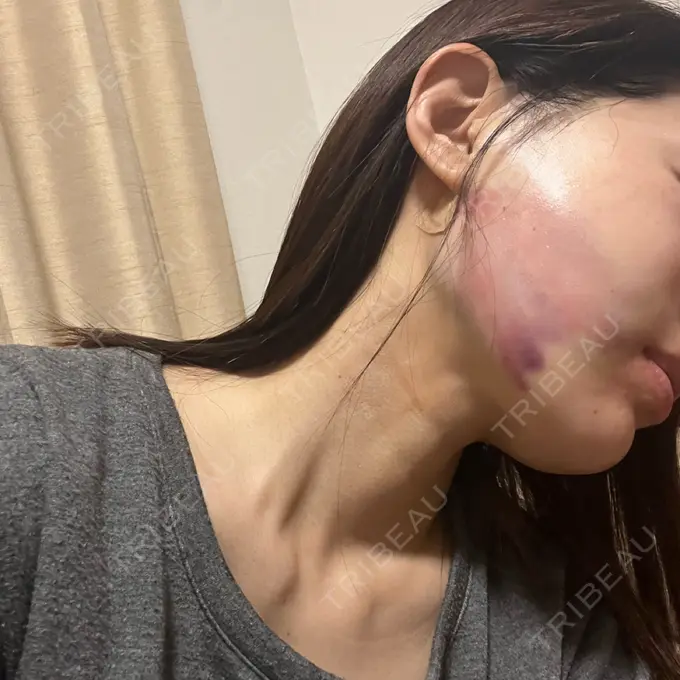 糸リフト / バッカルファット除去 / 脂肪吸引（顔） / ジョールファット除去 / ヒアルロン酸注入（あご） RIVER CLINIC（リバークリニック） DAY 0 メイン用