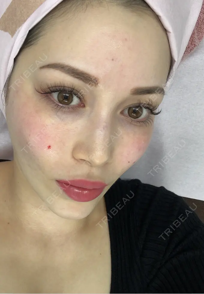 ボトックス（眉間） / 肌育注射（ジュベルックなど） / その他（肌） ルラ美容クリニック 渋谷本院 AFTER メイン用