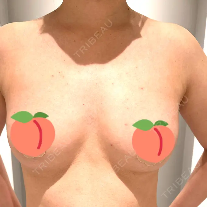 脂肪吸引（二の腕） / 脂肪吸引（脚） / 豊胸（脂肪注入） Mods Clinic（モッズクリニック） 名古屋院 DAY 90 メイン用