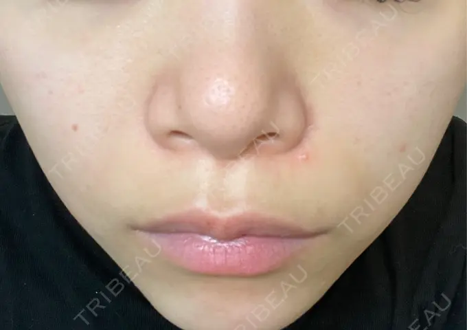 ルメッカ ハナビューティークリニック AFTER メイン用