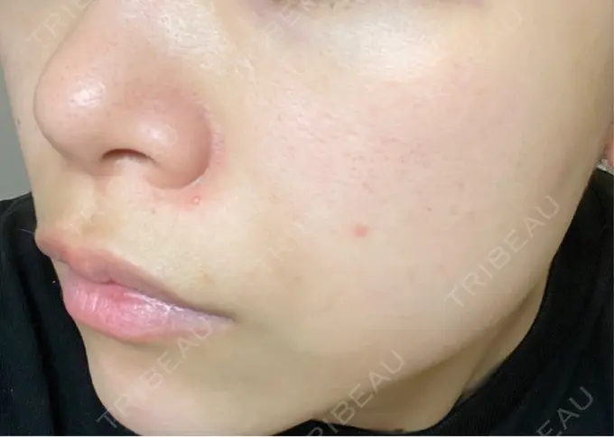 ルメッカ ハナビューティークリニック DAY 1 メイン用