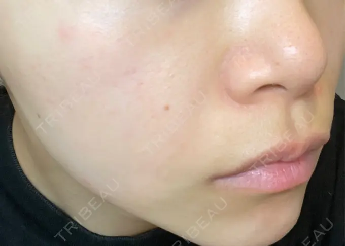 ルメッカ ハナビューティークリニック DAY 1 メイン用