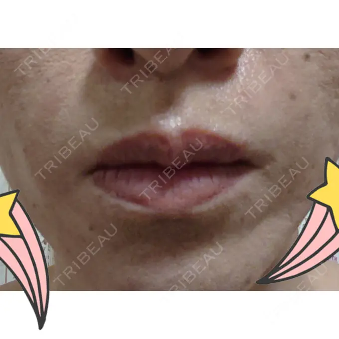 脂肪注入（肌） 広島プルミエクリニック DAY 13 メイン用