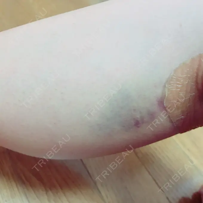 ボトックス（ふくらはぎ） REYOUNGクリニック DAY 4 メイン用