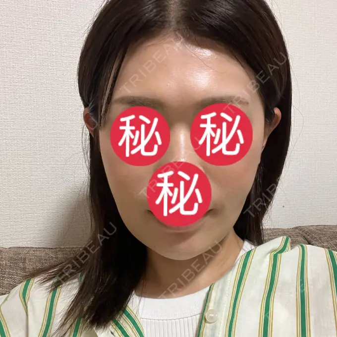 糸リフト / バッカルファット除去 / 脂肪吸引（顔） / ジョールファット除去 / ヒアルロン酸注入（あご） RIVER CLINIC（リバークリニック） AFTER メイン用