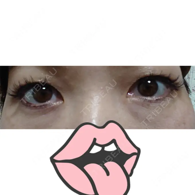 下まぶたたるみ取り 広島プルミエクリニック DAY 13 メイン用