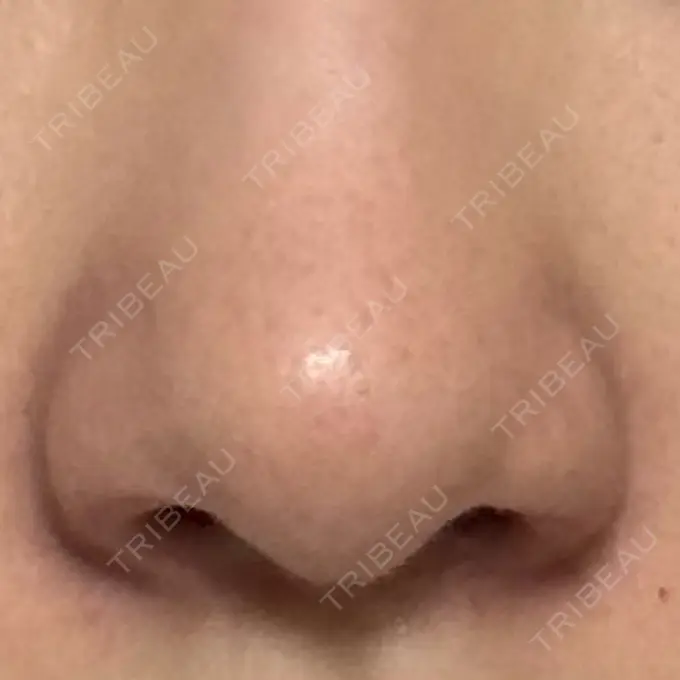 鼻孔縁挙上 シエルクリニック DAY 28 メイン用