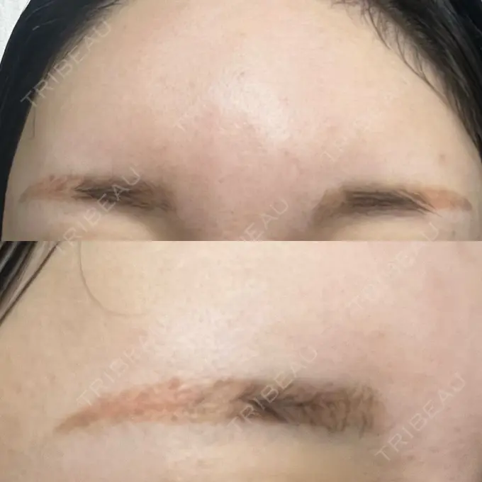 アートメイク（眉） / アートメイク除去・修正 表参道メディカルクリニック 横浜院	 AFTER メイン用