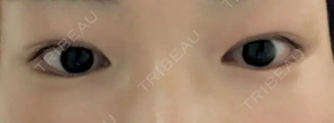 二重埋没 聖心美容クリニック 六本木院 DAY 7 メイン用