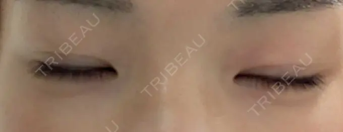 二重埋没 聖心美容クリニック 六本木院 DAY 7 メイン用