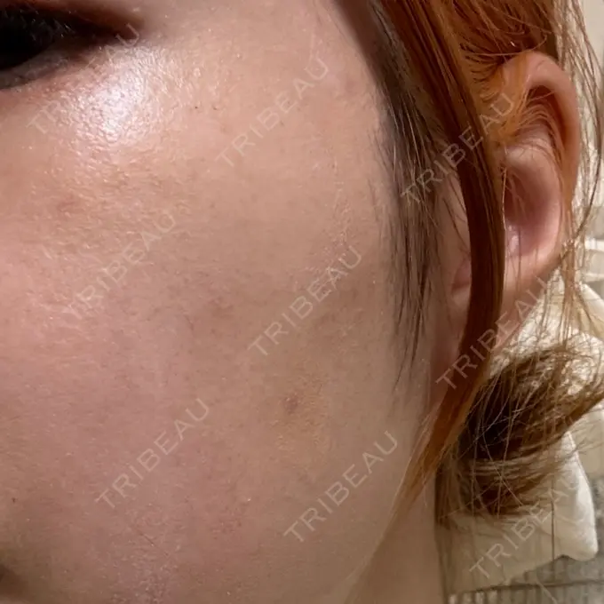 ほくろ・いぼ除去レーザー（肌） Mavie Beauty Clinic （マヴィービューティークリニック） DAY 23 メイン用