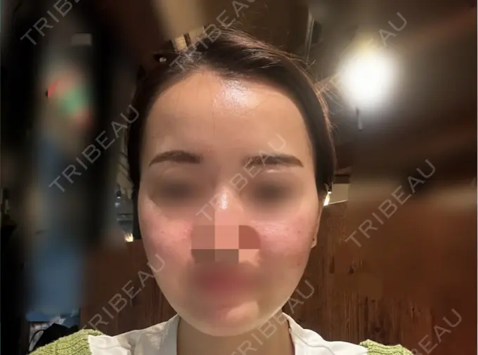 糸リフト / バッカルファット除去 / 脂肪吸引（顔） / ヒアルロン酸注入（あご） / ボトックス（エラ・小顔） RIVER CLINIC（リバークリニック） AFTER メイン用