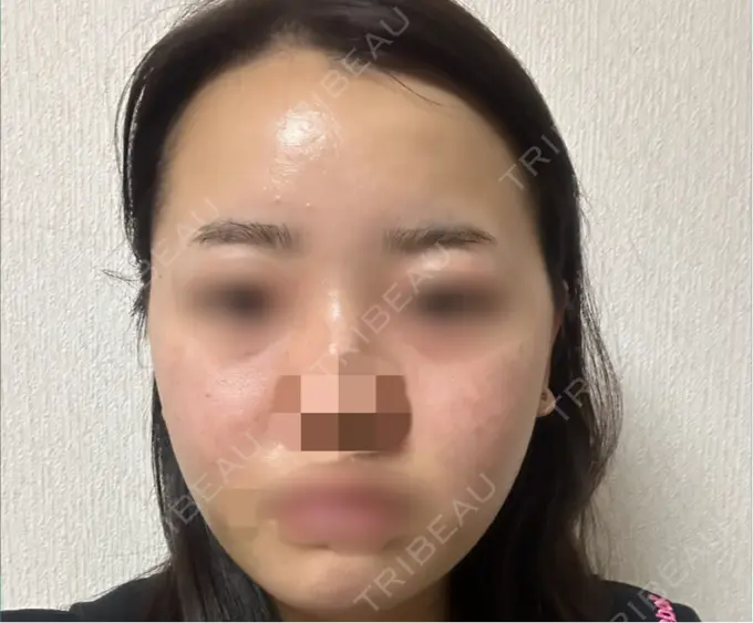 糸リフト / バッカルファット除去 / 脂肪吸引（顔） / ヒアルロン酸注入（あご） / ボトックス（エラ・小顔） RIVER CLINIC（リバークリニック） DAY 3 メイン用